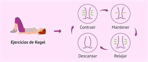 Ilustración mostrando la correcta ejecución de los ejercicios de Kegel.
