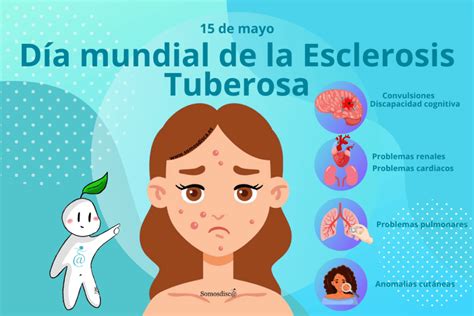 Esquema visual de los órganos afectados por la esclerosis tuberosa, mostrando hamartomas en cerebro, riñones, piel, corazón y pulmones