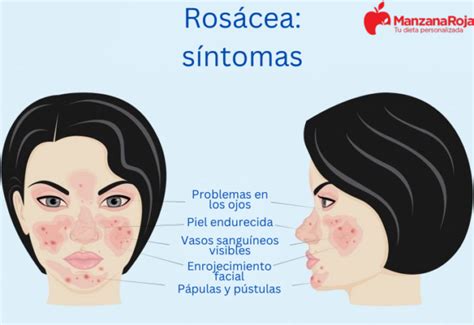 Infografía detallada sobre los síntomas comunes de la rosácea