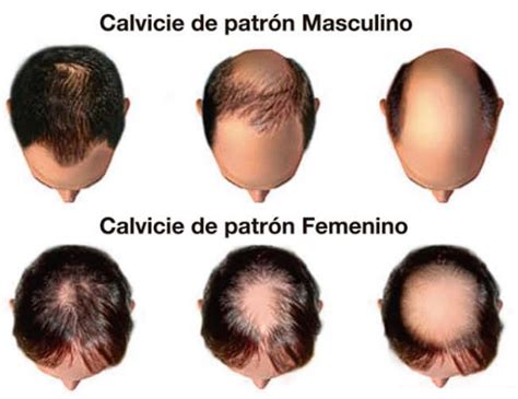Collage de imágenes mostrando diferentes tipos de cabello y calvicie en hombres y mujeres