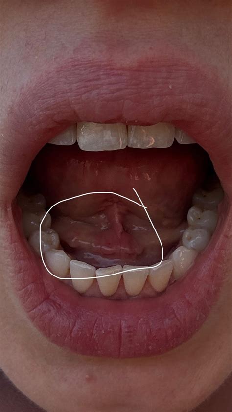 Foto clínica de una ránula simple debajo de la lengua