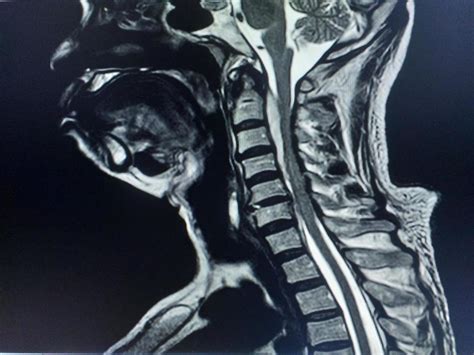 Resonancia magnética de una ránula cervical