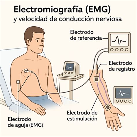 Infografía detallada del funcionamiento de la electromiografía y la conducción nerviosa