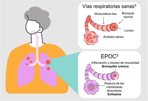 diagrama comparando pulmones sanos y pulmones afectados por EPOC (enfisema y bronquitis)