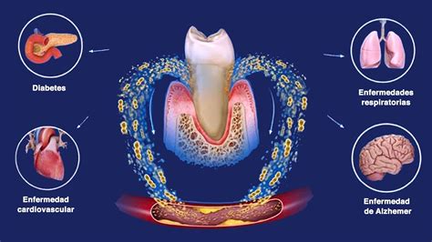 Esquema de la relación entre inflamación periodontal y enfermedades neurológicas