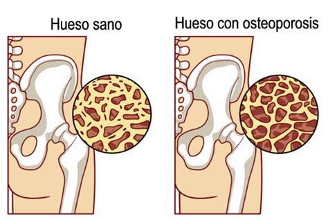 comparación gráfica entre un hueso sano y un hueso con osteoporosis mostrando la densidad ósea