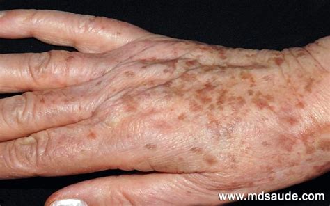 Foto de léntigos solares en el dorso de la mano de una persona mayor