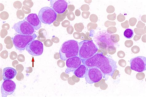 Fotografía del efecto del tratamiento con inhibidores de ATR en un modelo de leucemia mieloide aguda en ratón.