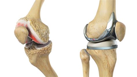 Ilustración de una rodilla con artrosis antes y después de una artroplastia total de rodilla.