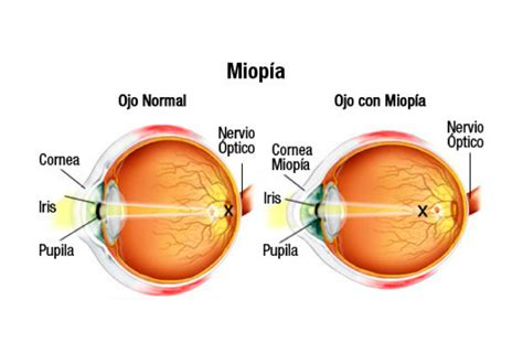 Esquema del ojo humano con enfoque de la miopía magna