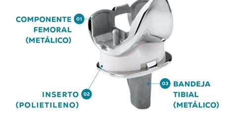 Esquema detallado de una prótesis de rodilla con indicación de sus partes metálicas