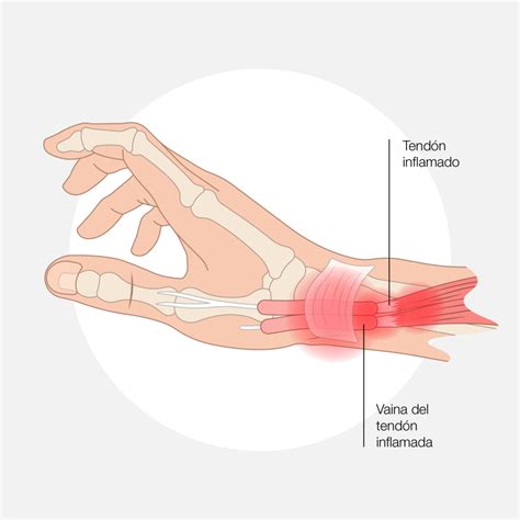 Esquema anatómico de la muñeca mostrando la vaina del tendón inflamada en la base del pulgar.
