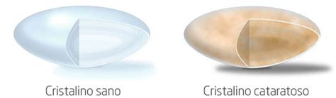 Esquema anatómico comparativo entre un cristalino sano y uno con catarata opacificada.