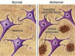 Diagrama que muestra la formación de placas amiloides y ovillos neurofibrilares en el cerebro de un paciente con Alzheimer.