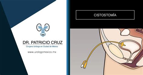 Ilustración de las dos técnicas principales para la colocación de una cistostomía: por punción con trocar y por incisión quirúrgica.