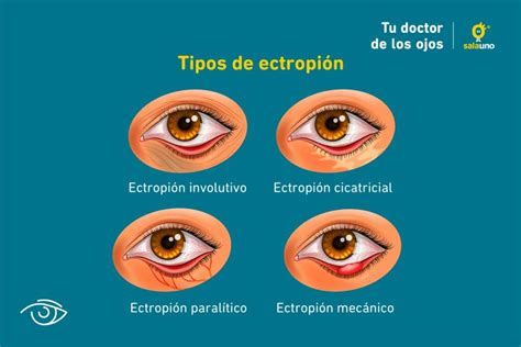 Ojo de una persona mayor con signos de ectropión