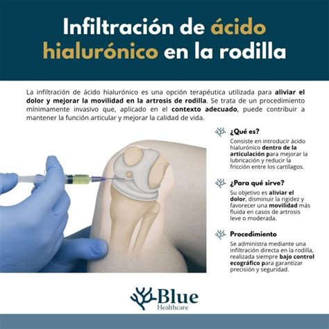 Esquema de las diferentes técnicas de inyección en la rodilla (corticosteroides, ácido hialurónico, PRP)