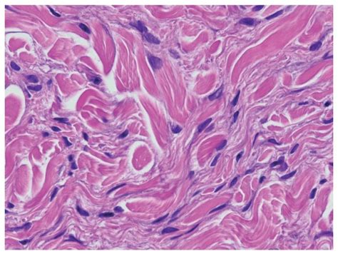 Esquema: Áreas corporales frecuentemente afectadas por la fibrosis sistémica nefrogénica