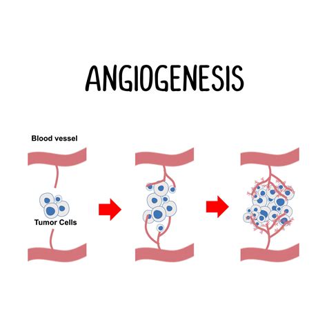 Infografía sobre la angiogénesis tumoral y cómo los inhibidores de la angiogénesis pueden 