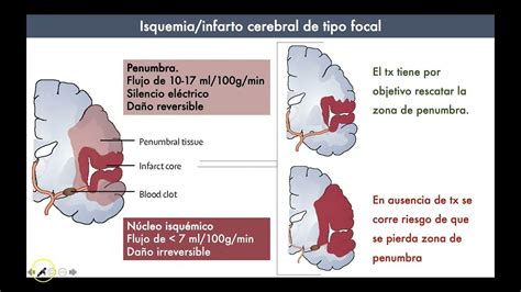 Ilustración de una región cerebral específica afectada por una deficiencia neurológica focal