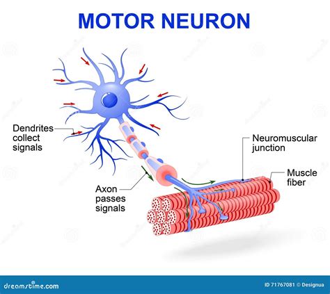 Diagrama de neuronas motoras sanas y neuronas motoras dañadas en una enfermedad degenerativa
