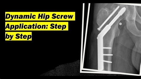 Esquema o fotografía de un DHS (Dynamic Hip Screw) in situ.