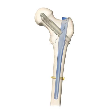 Esquema o fotografía de un PFN (Proximal Femoral Nail) in situ.