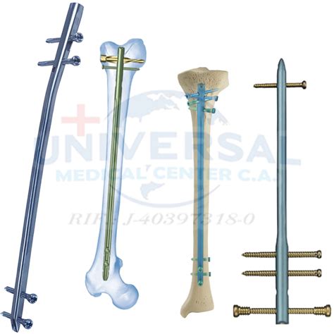Imágenes de diferentes tipos de placas y clavos utilizados en osteosíntesis.