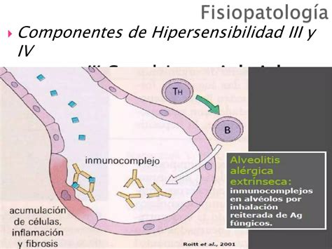 Diagrama de las fases patogénicas de la neumonitis por hipersensibilidad