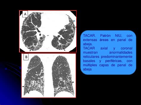 Imagen de TACAR de tórax mostrando patrón en mosaico en neumonitis por hipersensibilidad