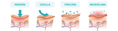 Infografía: Mecanismos de formación de las UPP (presión, fricción, cizallamiento y humedad).