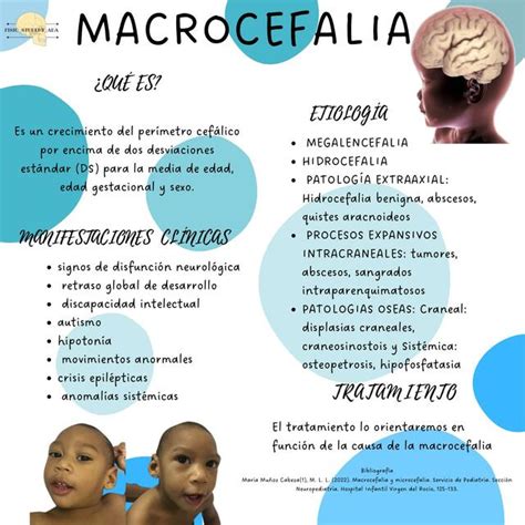 Fotografía de un bebé con macrocefalia, un signo común de hidrocefalia infantil