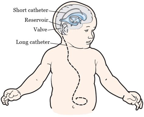 Esquema de la inserción de una derivación ventrículo-peritoneal (shunt) para el tratamiento de la hidrocefalia
