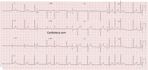 Ejemplo de ECG con fibrilación auricular