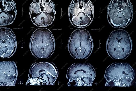 Resonancia magnética cerebral mostrando una anomalía cortical