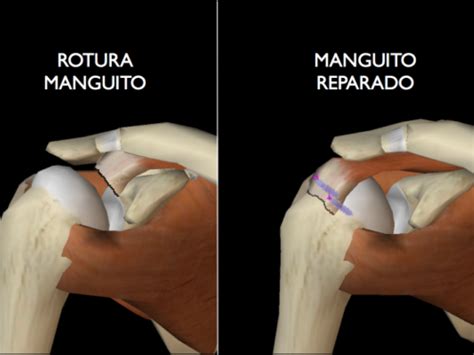 Infografía: Tipos de problemas de hombro en ancianos (manguito rotador, artrosis, pinzamiento)