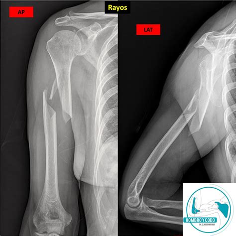 Radiografía de fractura proximal de húmero