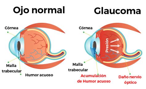 Infografía sobre el glaucoma y el daño al nervio óptico