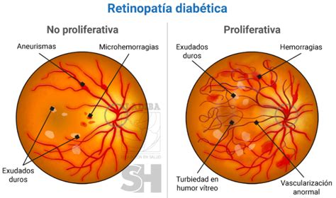 Diagrama de los vasos sanguíneos de la retina afectados por la retinopatía diabética