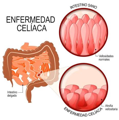 Esquema del intestino delgado sano y afectado por la enfermedad celíaca, mostrando el daño a las vellosidades