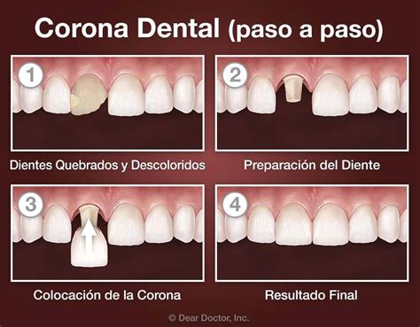 ilustración de una corona dental colocada sobre un diente dañado