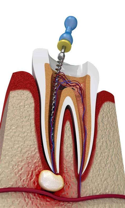 esquema detallado de un tratamiento de conductos dentales