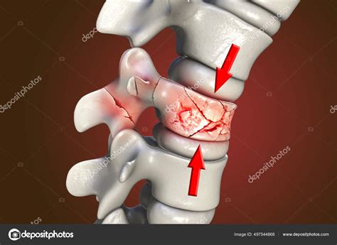 Ilustración de una columna vertebral con una fractura por aplastamiento