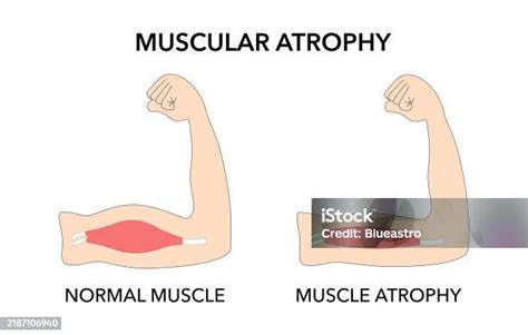 Ilustración que muestra la atrofia muscular y la disminución de la densidad ósea debido a la inmovilidad