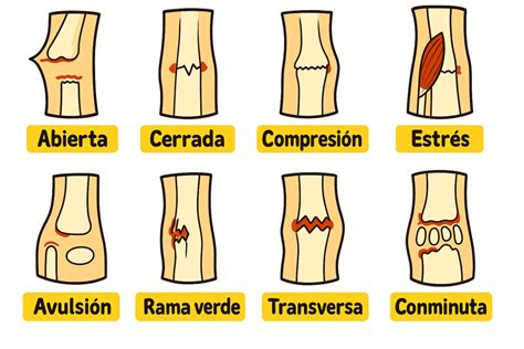 Esquema de las fracturas más comunes en personas mayores
