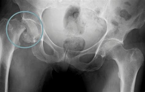 Radiografía de una fractura de cadera en un anciano