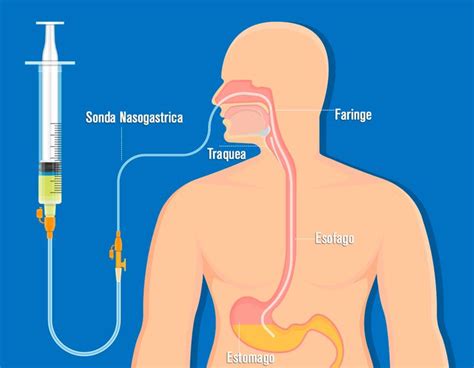 diagrama de sonda nasogástrica y gastrostomía mostrando su colocación