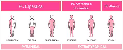 Esquema que clasifica la parálisis cerebral según la topografía (hemiplejía, diplejía, tetraplejía) y la naturaleza del trastorno motor (espástica, discinética, atáxica).