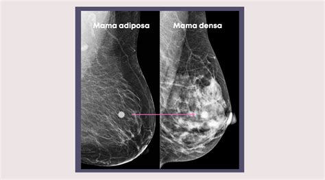 Mamografía que muestra tejido mamario normal y tejido mamario canceroso