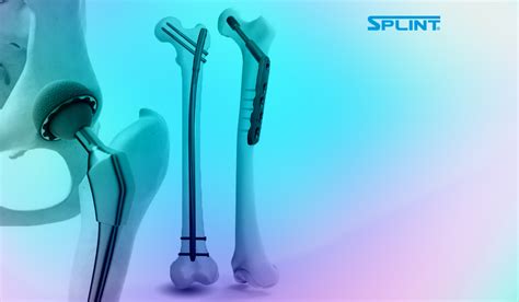 Esquema de un DHS (dinamic hip screw) para fractura de cadera